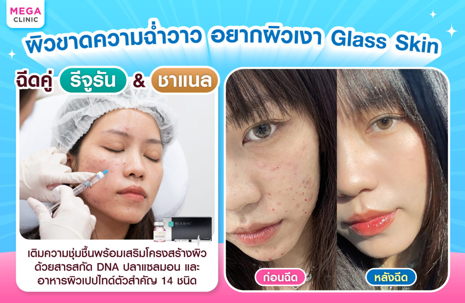 ฉีดหน้าใส คู่กับฉีดรีจูรัน และฉีดชาแนล