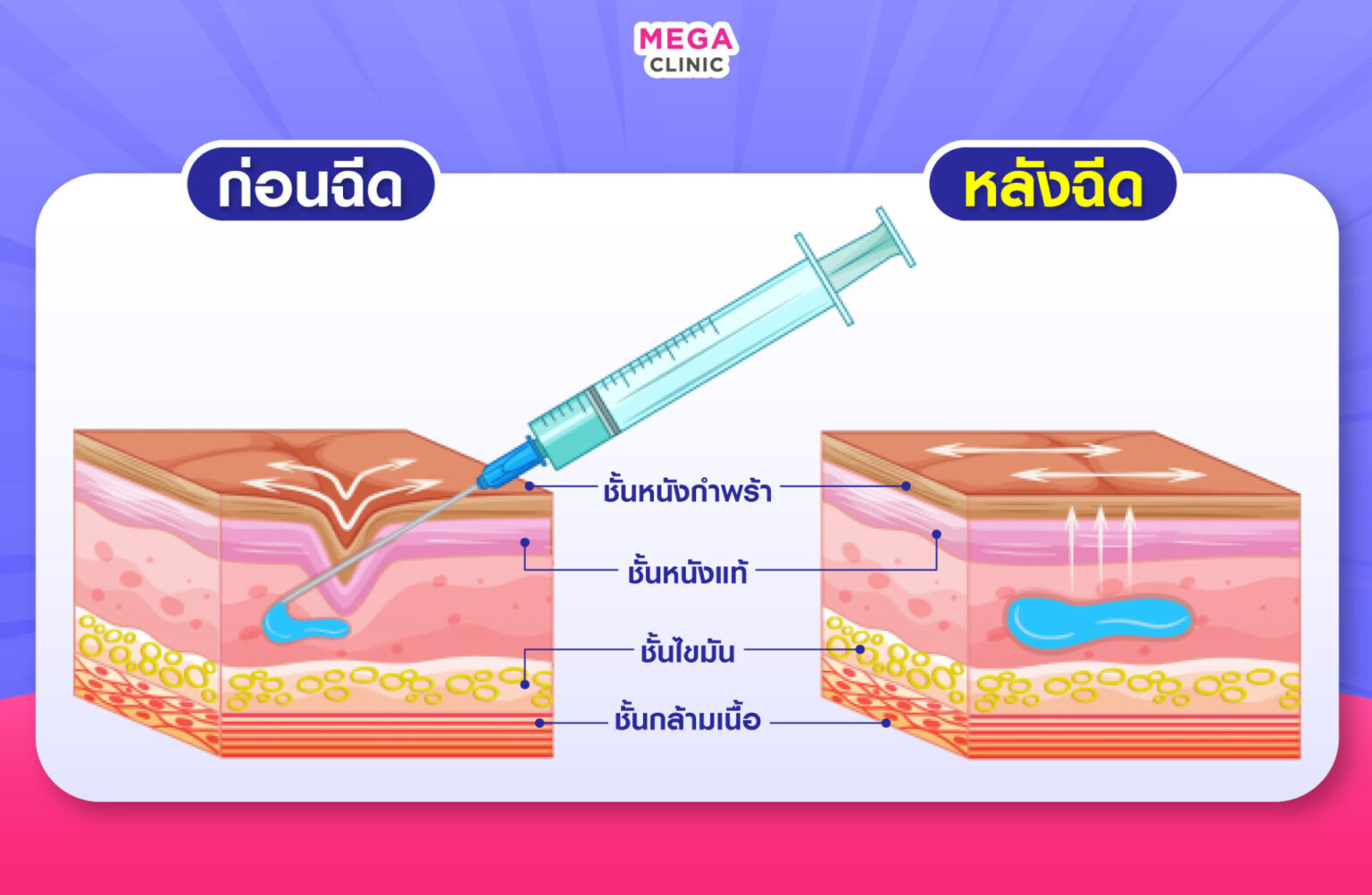 ภาพการทำงานของฟิลเลอร์