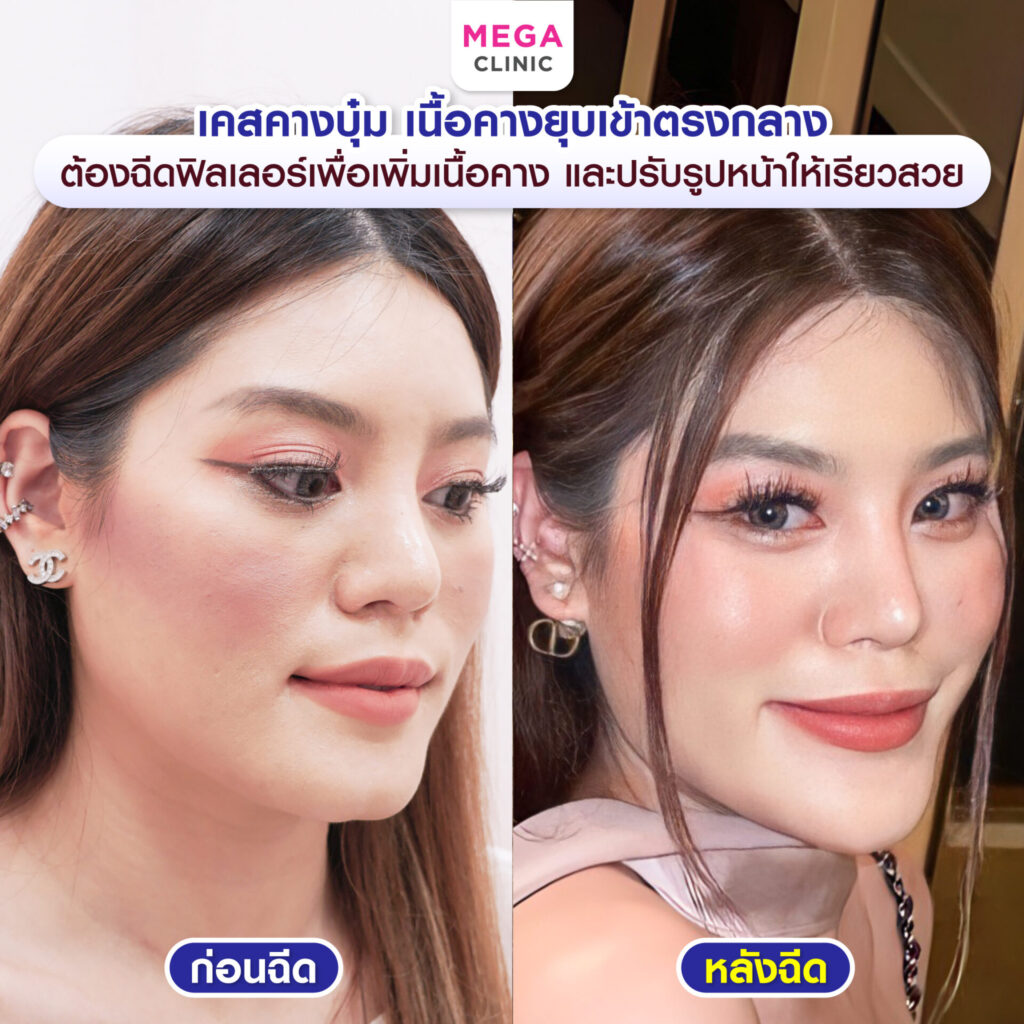 ปัญหาคางของคุณแจมก่อนฉีดฟิลเลอร์คาง