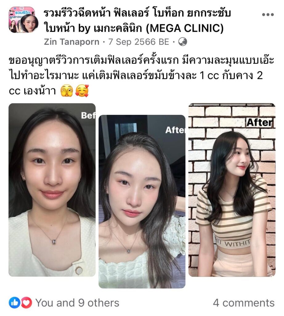 รีวิวฟิลเลอร์ขมับจาก Facebook Group