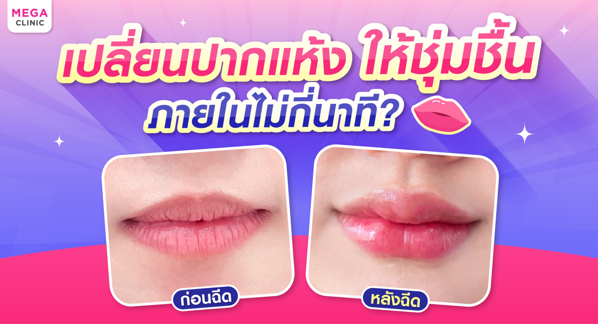 ปากแห้ง ลอกเป็นขุย แนะนำฉีดฟิลเลอร์ปาก