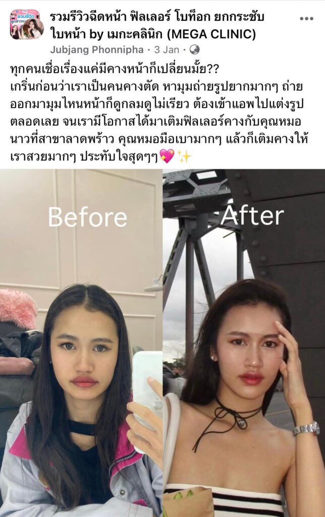 รีวิวฟิลเลอร์คางคุณจุ๊บแจง