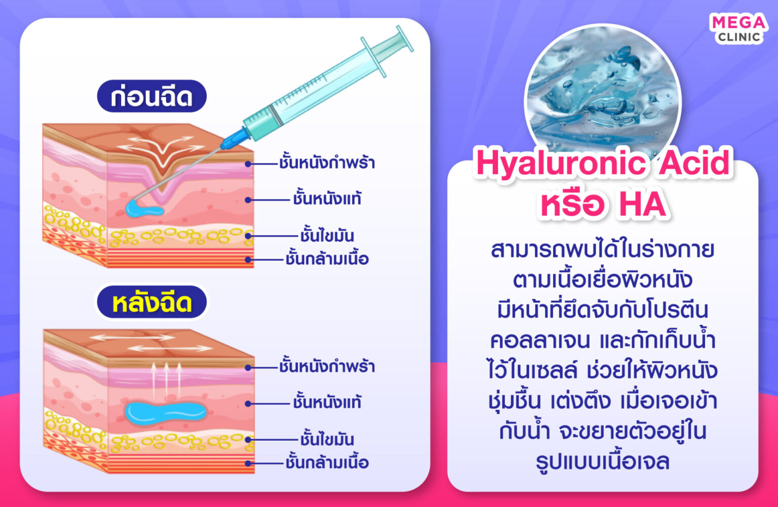 การทำงานของฟิลเลอร์ คืออะไร