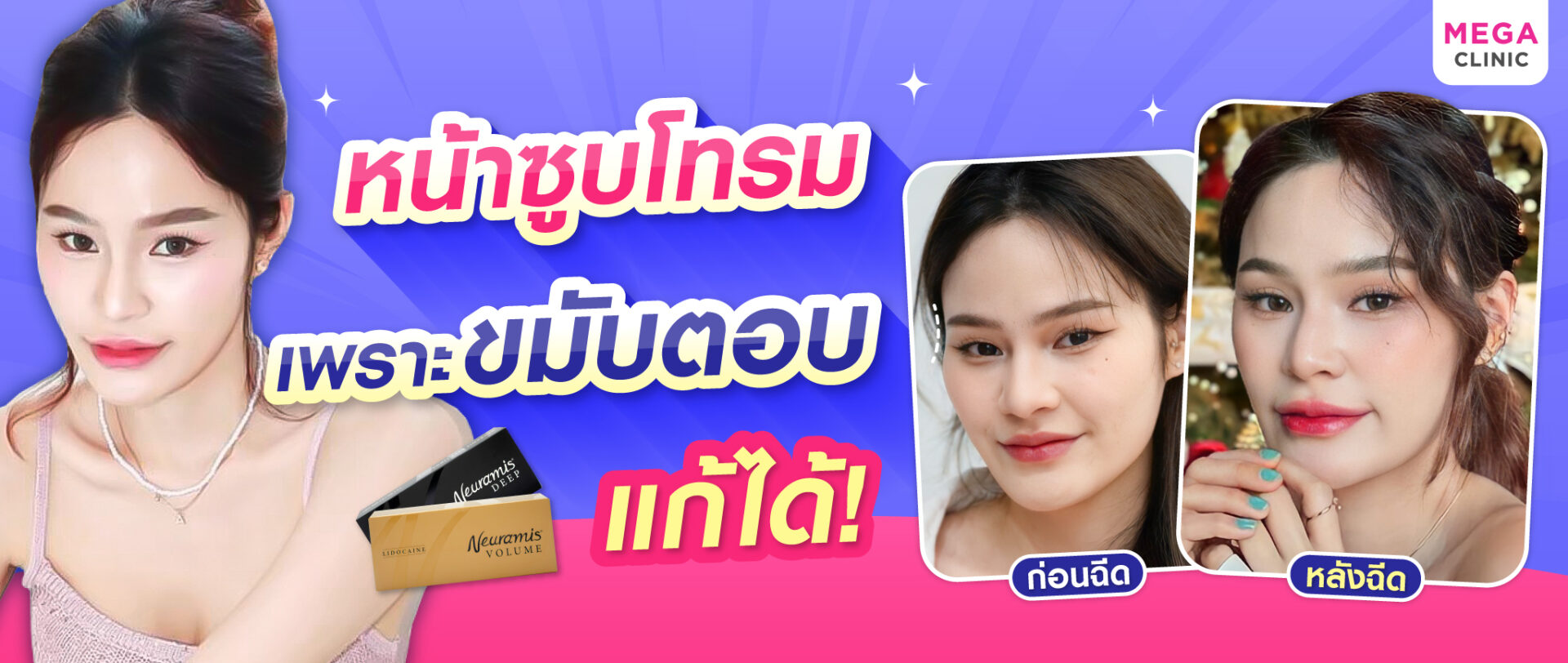 ฟิลเลอร์ขมับ แก้หน้าโทรม