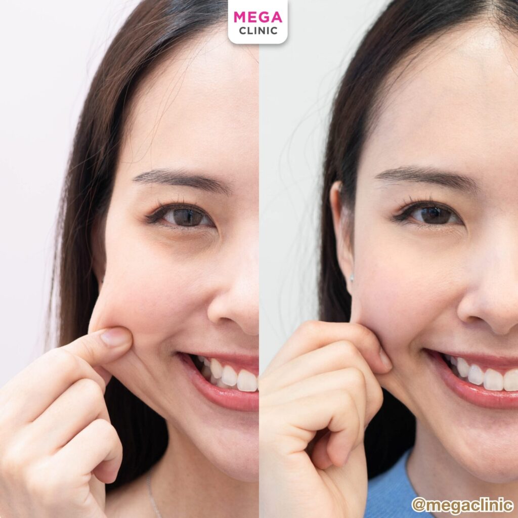 รีวิวฉีด Sculptra หน้าตรงคุณเฟื่องฟ้า