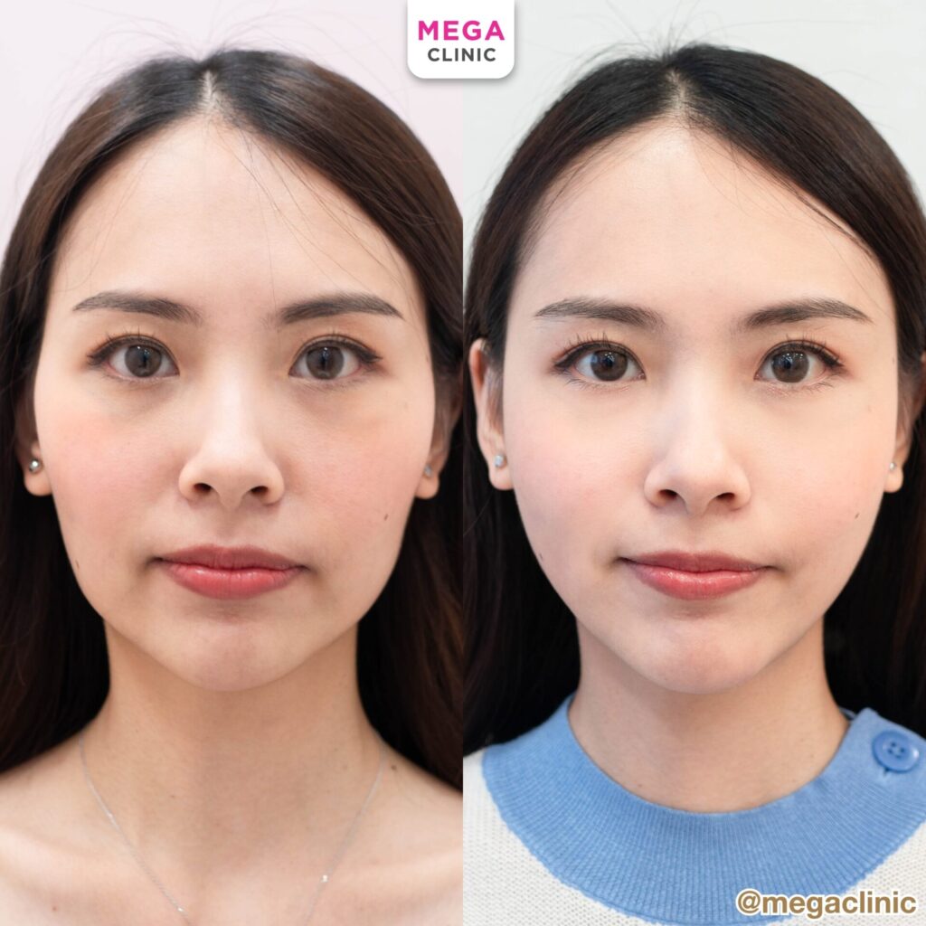 review Sculptra คุณเฟื้องฟ้า