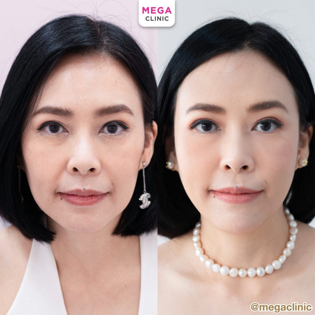 รีวิวฉีด Sculptra หน้าตรงคุณอ้อม