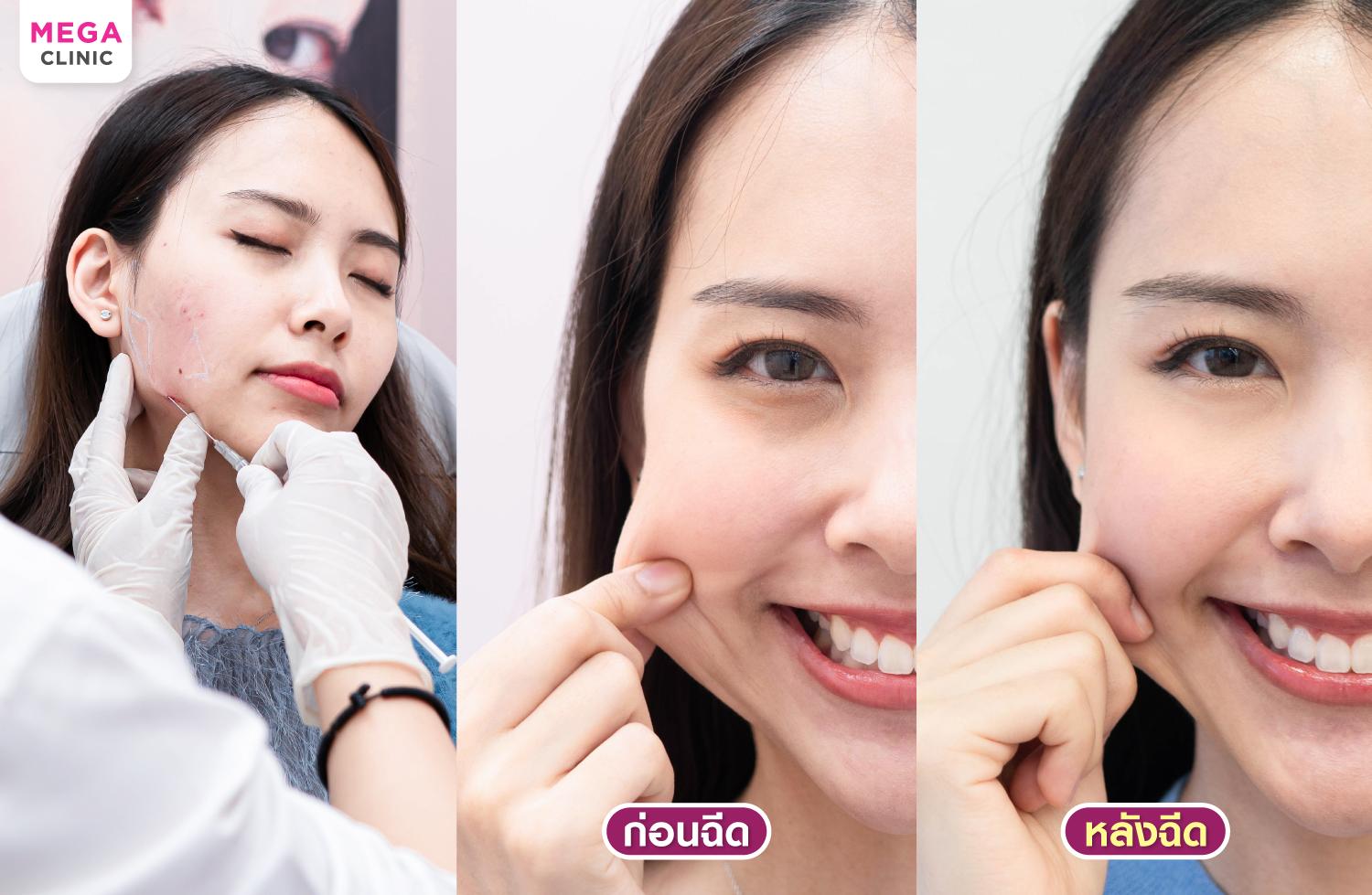 ภาพขณะฉีดและรีวิวฉีด Sculptra ฟื้นฟูให้ผิวดูเด็ก