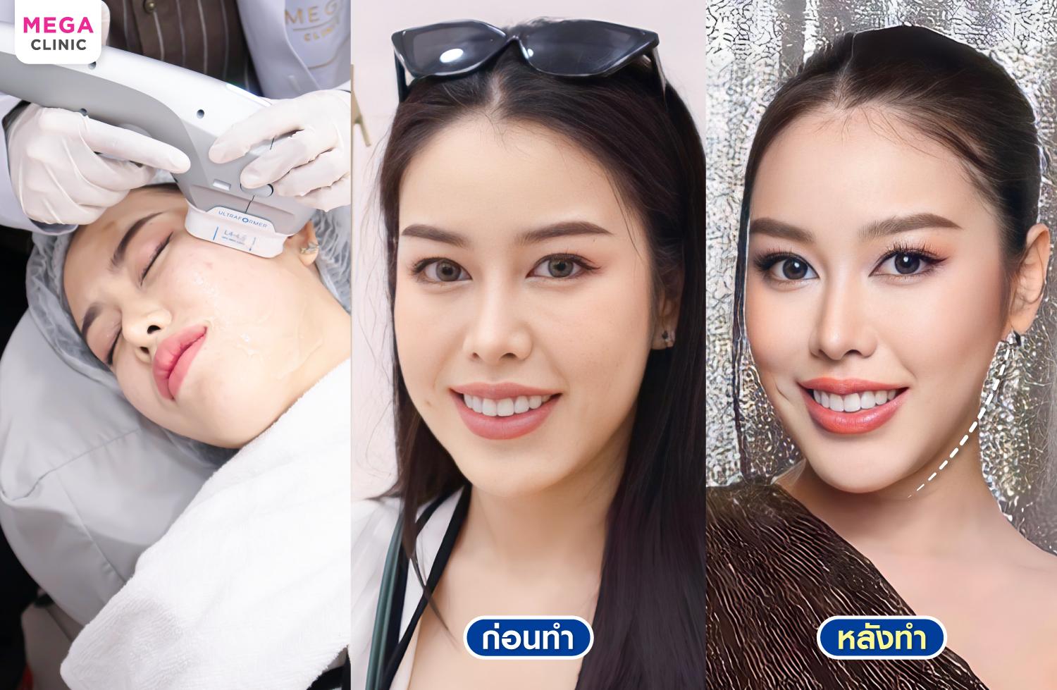 รีวิว Ultraformer III ยกกระชับ กับ MEGA CLINIC