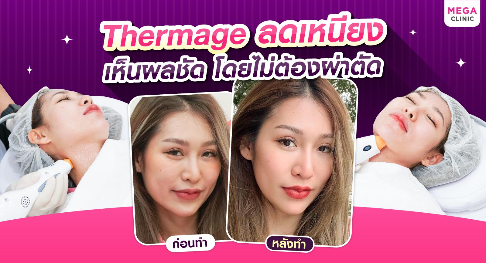 ลดเหนียงด้วย Thermage เห็นผลชัด โดยไม่ต้องผ่าตัด