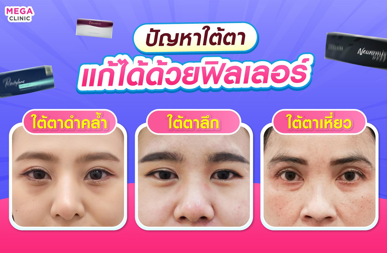 แก้ไขปัญหาใต้ตาด้วยฟิลเลอร์