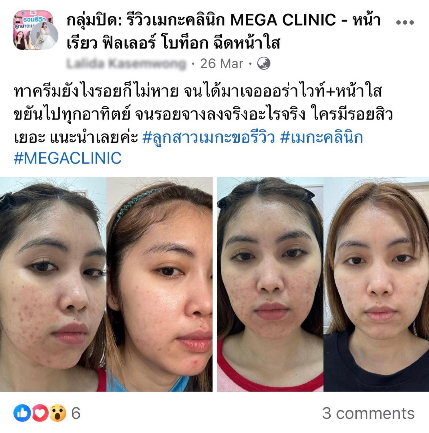 ฉีดออร่าไวท์ต่อเนื่อง รีวิวใน Facebook Group2