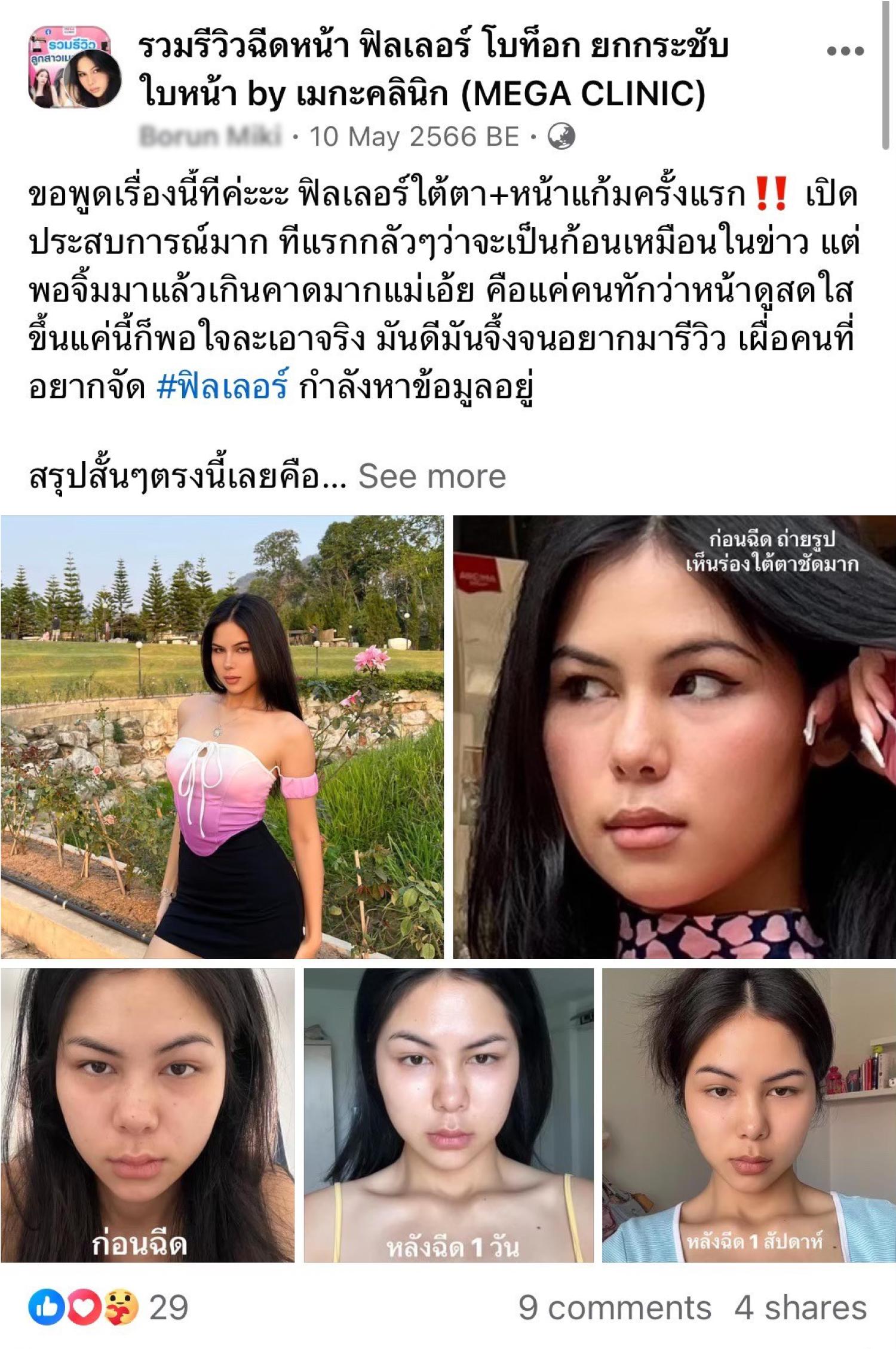 รีวิวฟิลเลอร์ใต้ตา คุณ Tungpang ที่เมกะคลินิก