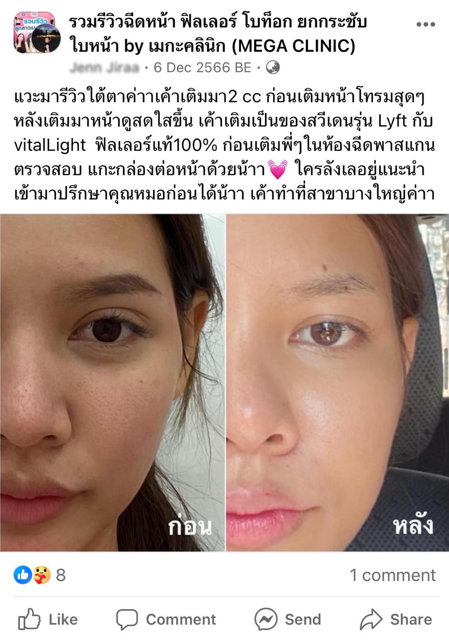 รีวิวฟิลเลอร์ใต้ตา คุณเอที่เมกะคลินิก