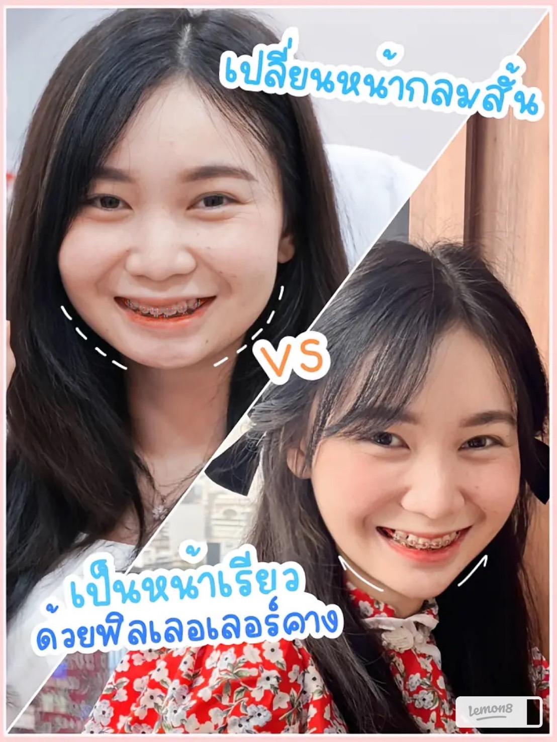 รีวิวหลังฉีดฟิลเลอร์คาง ที่เมกะคลินิก