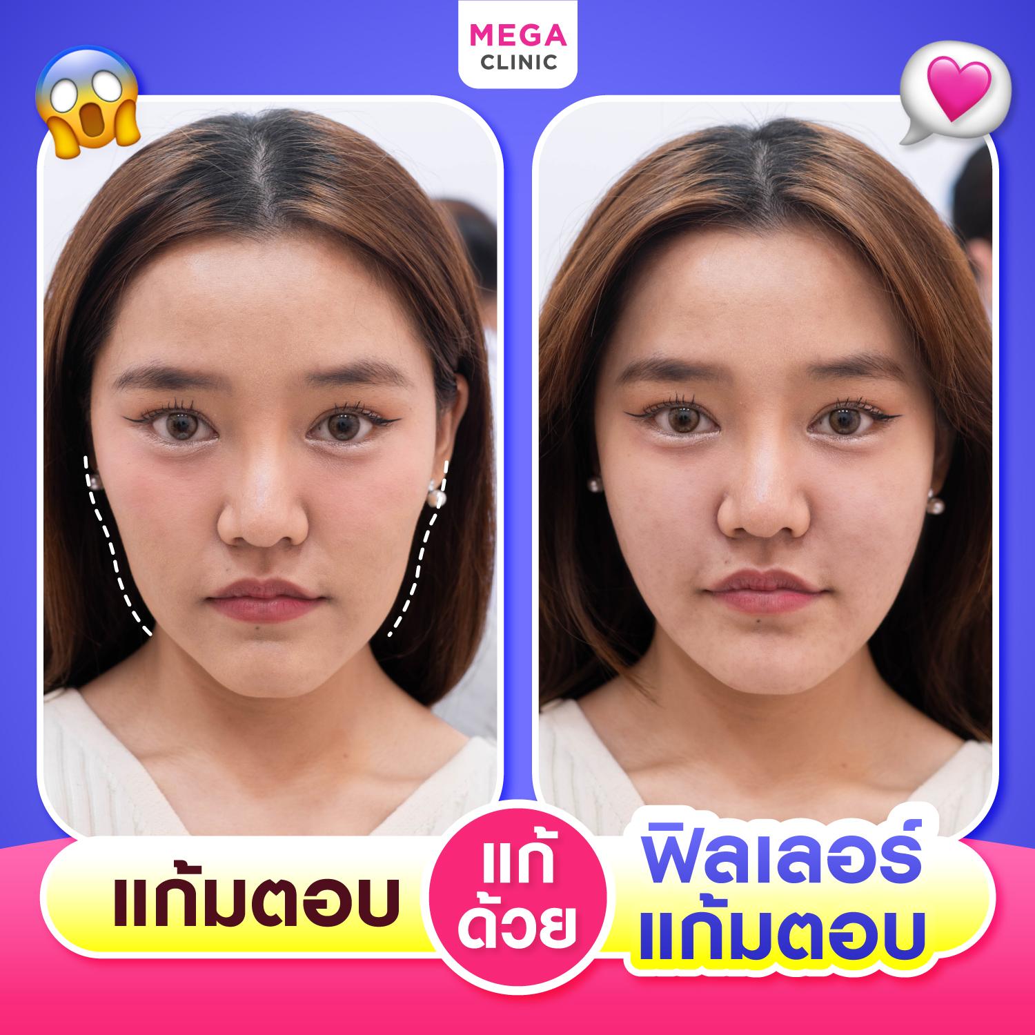 รีวิวปัญหาแก้มตอบ แก้ด้วยฟิลเลอร์