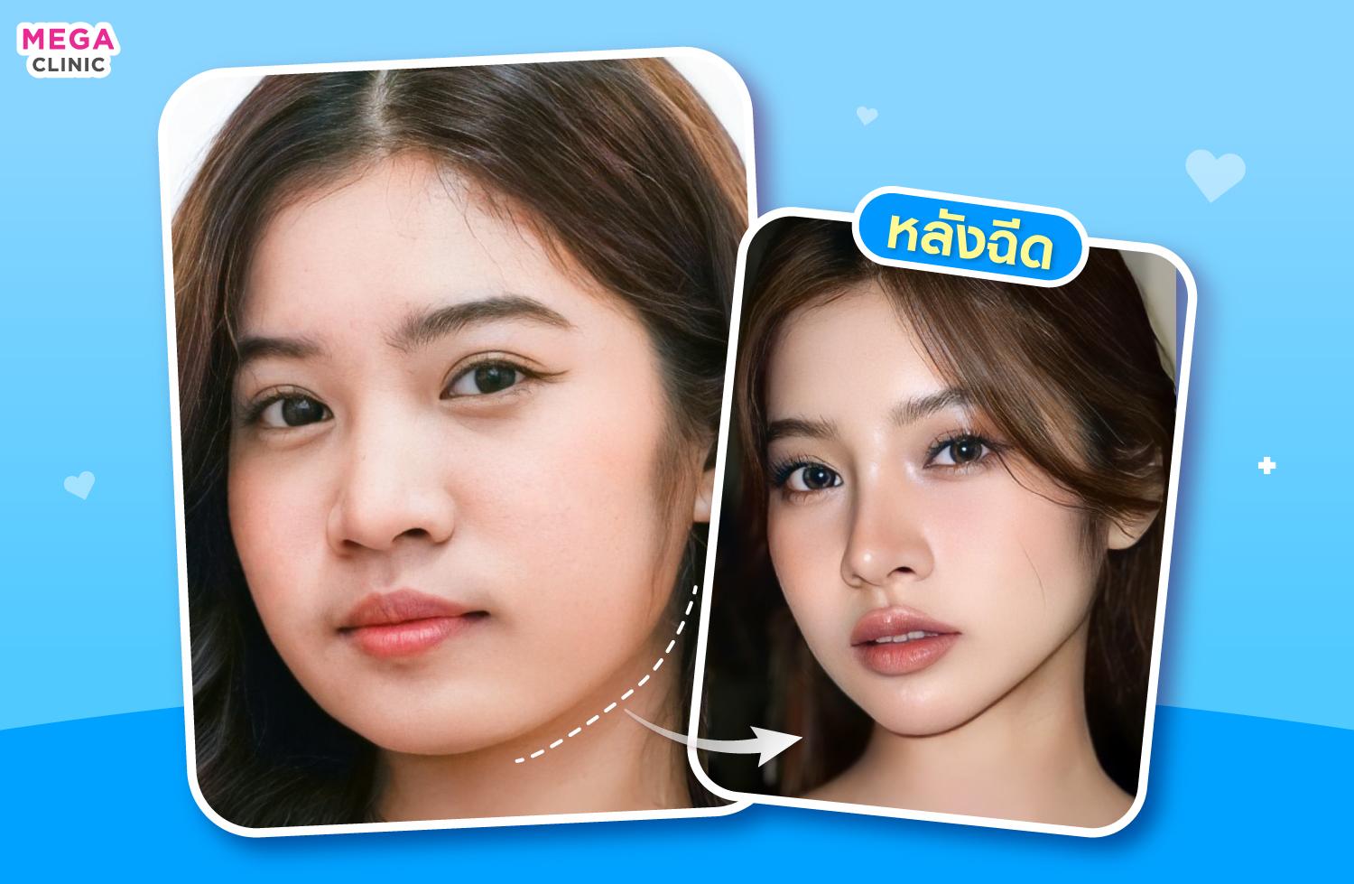 รีวิวหลังฉีดโบท็อกลดกราม แก้หน้าบาน