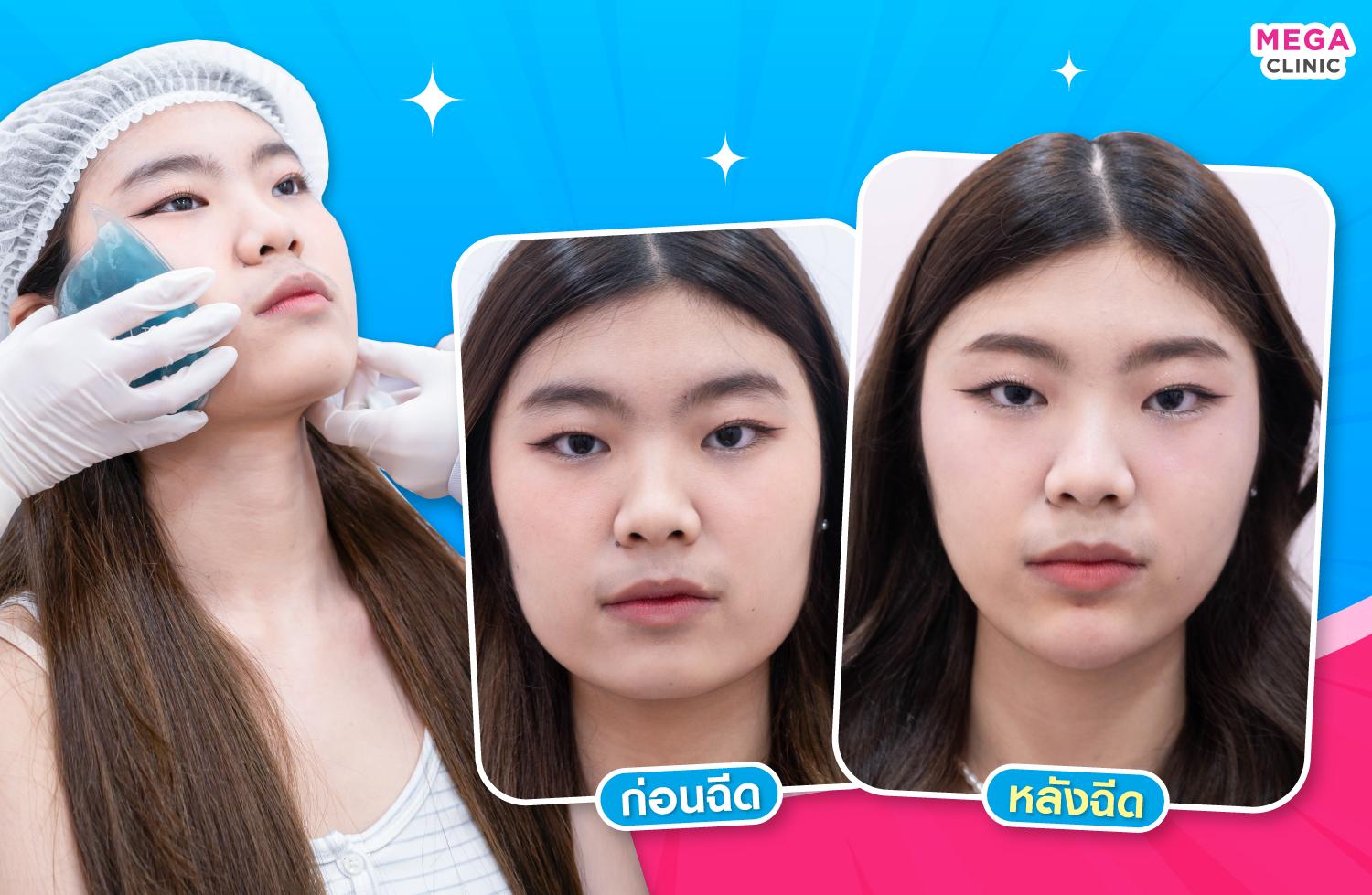 รีวิวโบท็อกลดกราม MEGA CLINIC