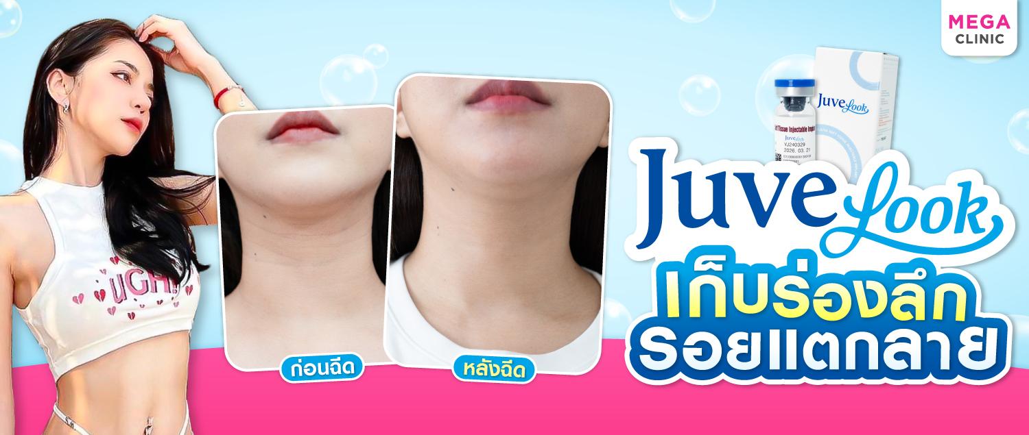 Juvelook คืออะไร? เก็บร่องลึก รอยแตกลายให้กลับมาเรียบเนียนได้จริงไหม