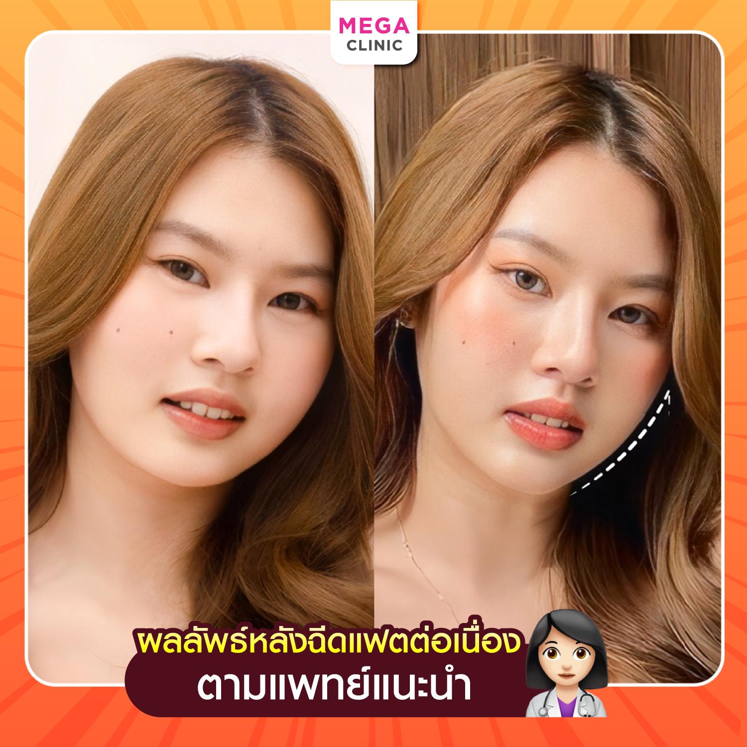 ผลลัพธ์หลังฉีดแฟตอย่างต่อเนื่อง