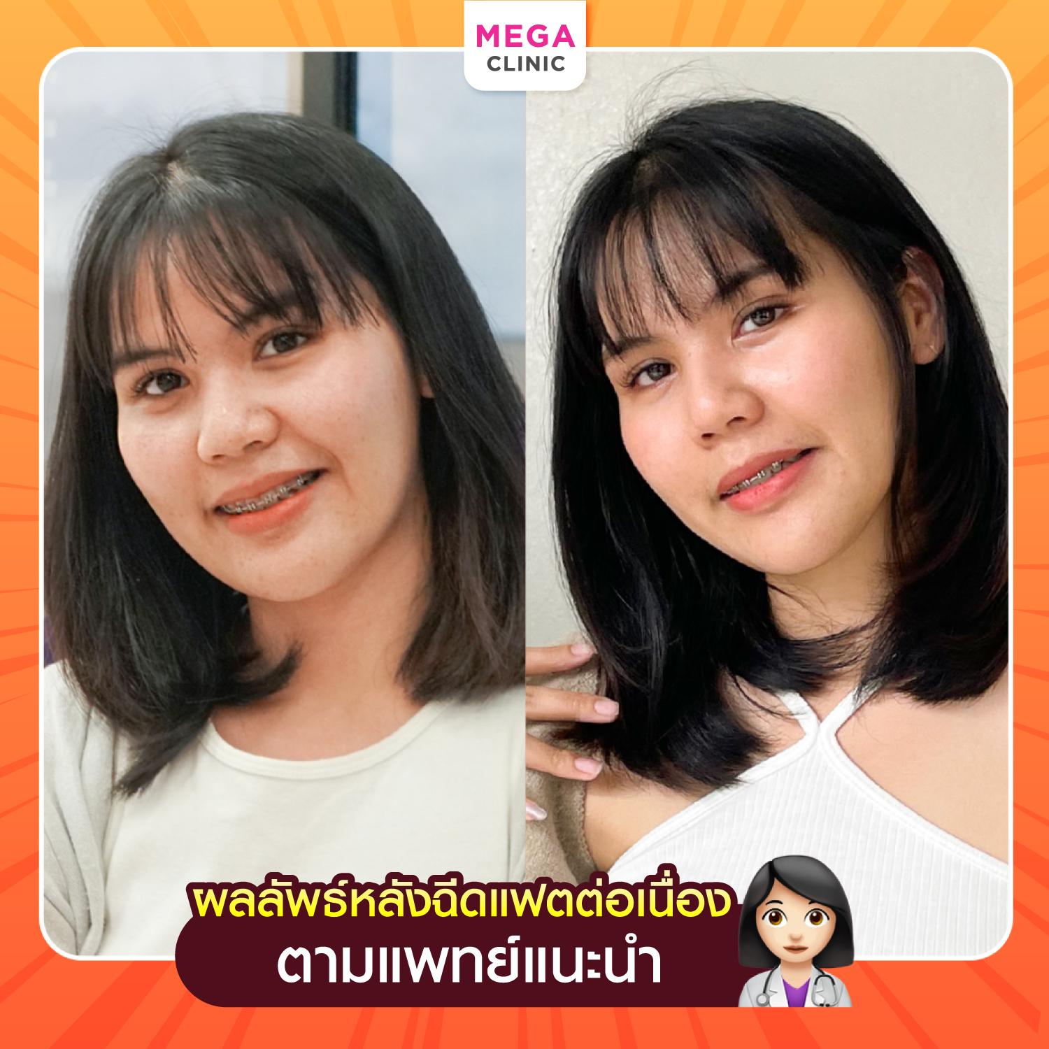 รีวิวผลลัพธ์หลังฉีดแฟตอย่างต่อเนื่อง