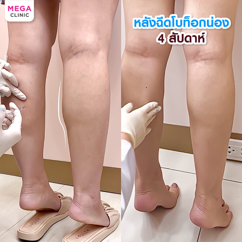 รีวิวโบท็อกลดน่อง