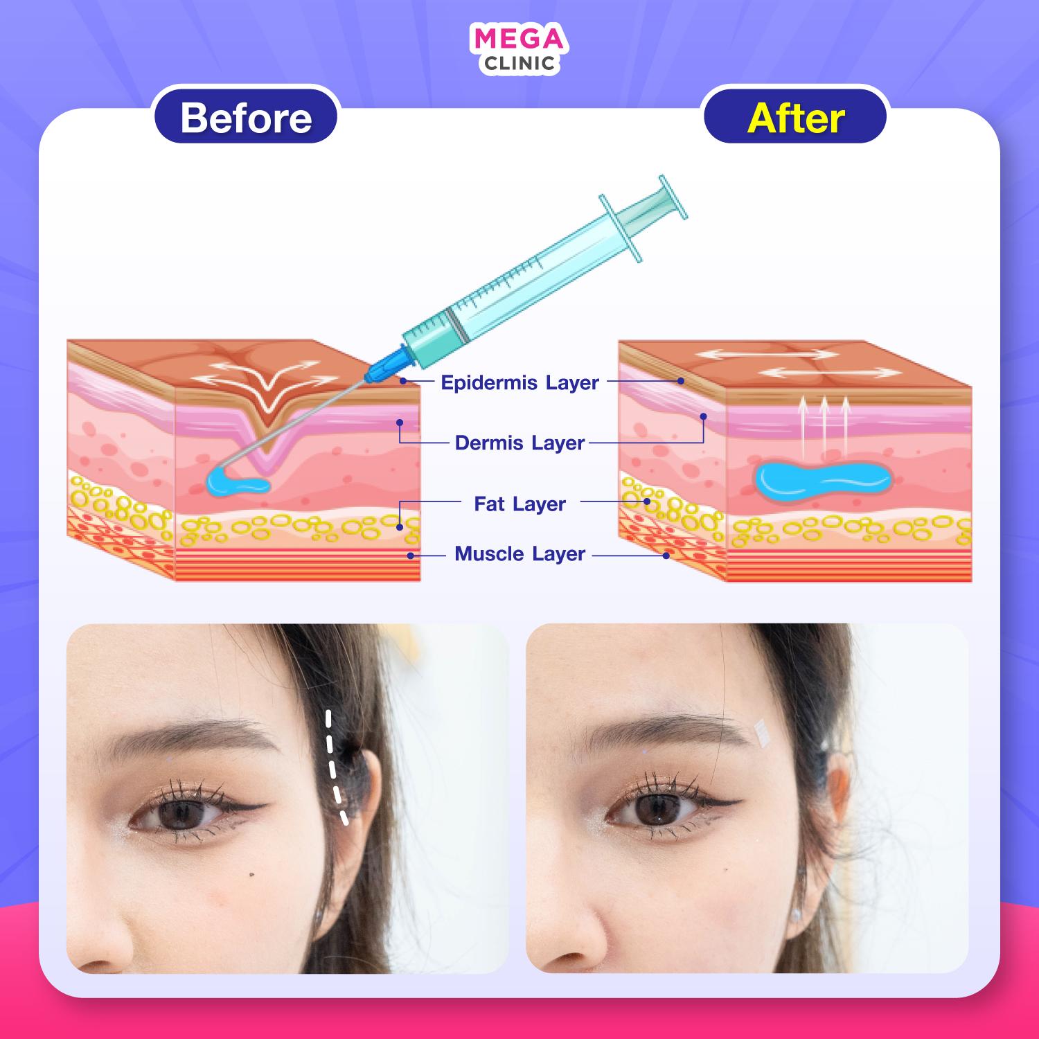 การทำงานของฟิลเลอร์ รีวิว ฟิลเลอร์ขมับแบบซูม