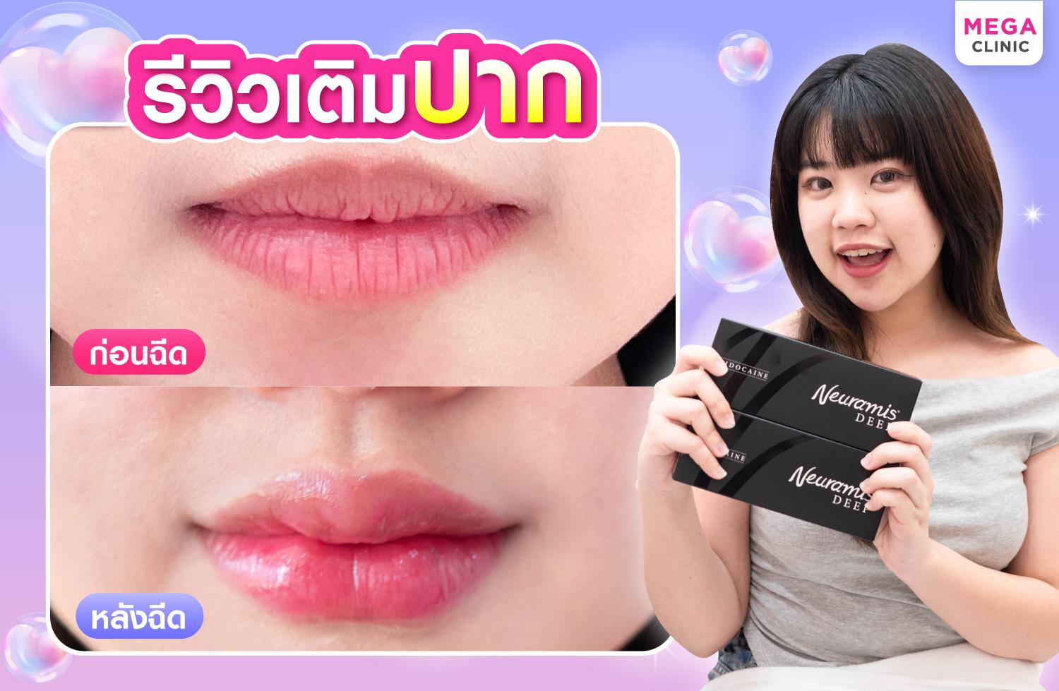 รีวิวเติมปาก ด้วยฟิลเลอร์ Neuramis