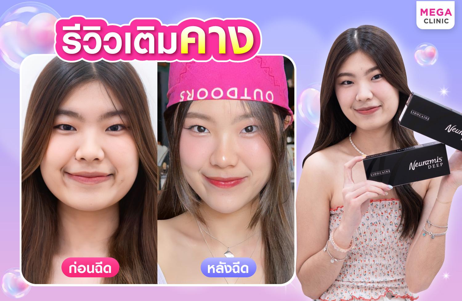 รีวิวเติมคาง ด้วยฟิลเลอร์ Neuramis