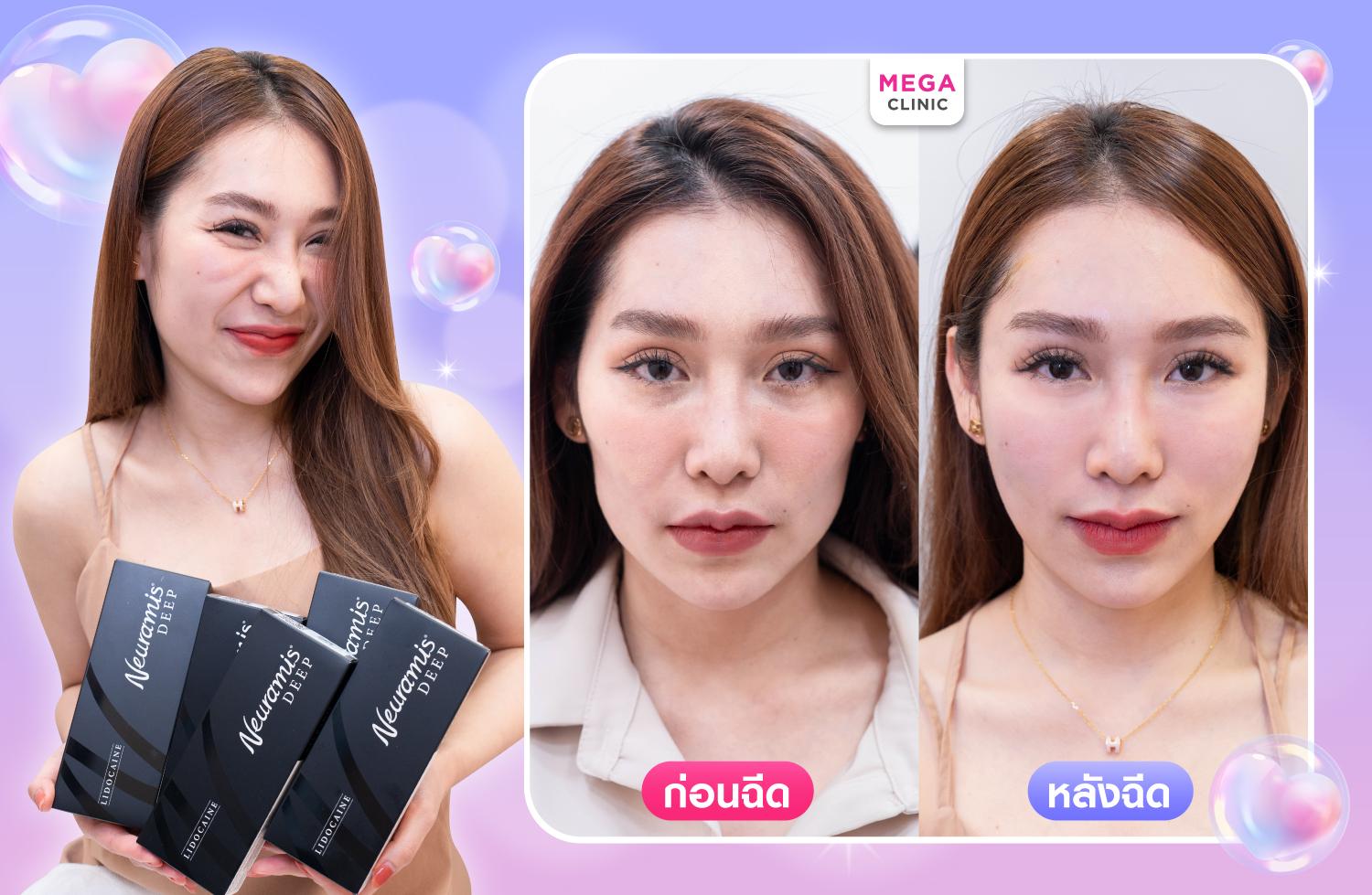 รีวิวเติมทั่วหน้าด้วยฟิลเลอร์ Neuramis คุณตู่