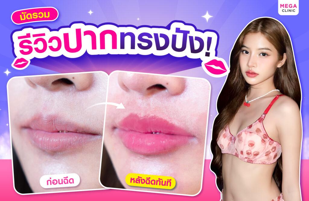 รีวิวหลังฉีดปาก คุณตูน