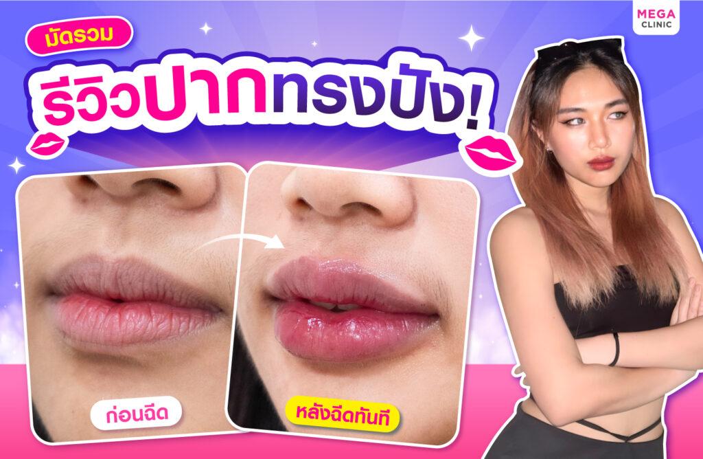 รีวิวฉีดฟิลเลอร์ปาก น้องพลอย