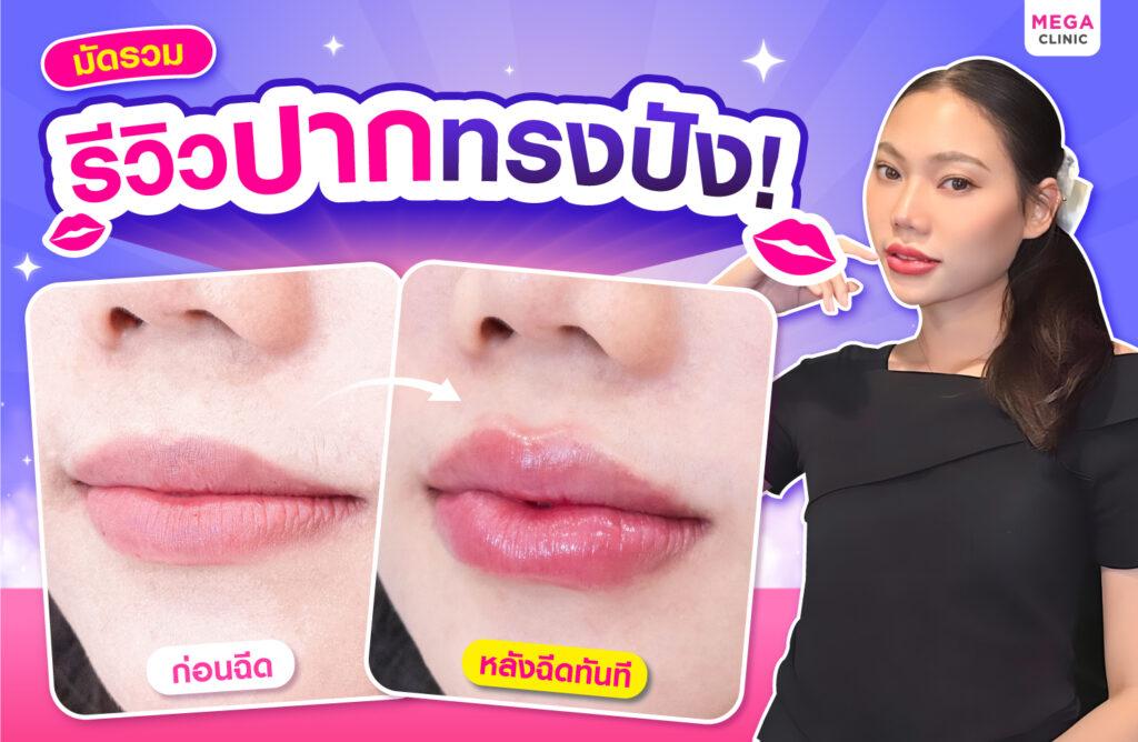 รีวิวหลังฉีดฟิลเลอร์ปาก