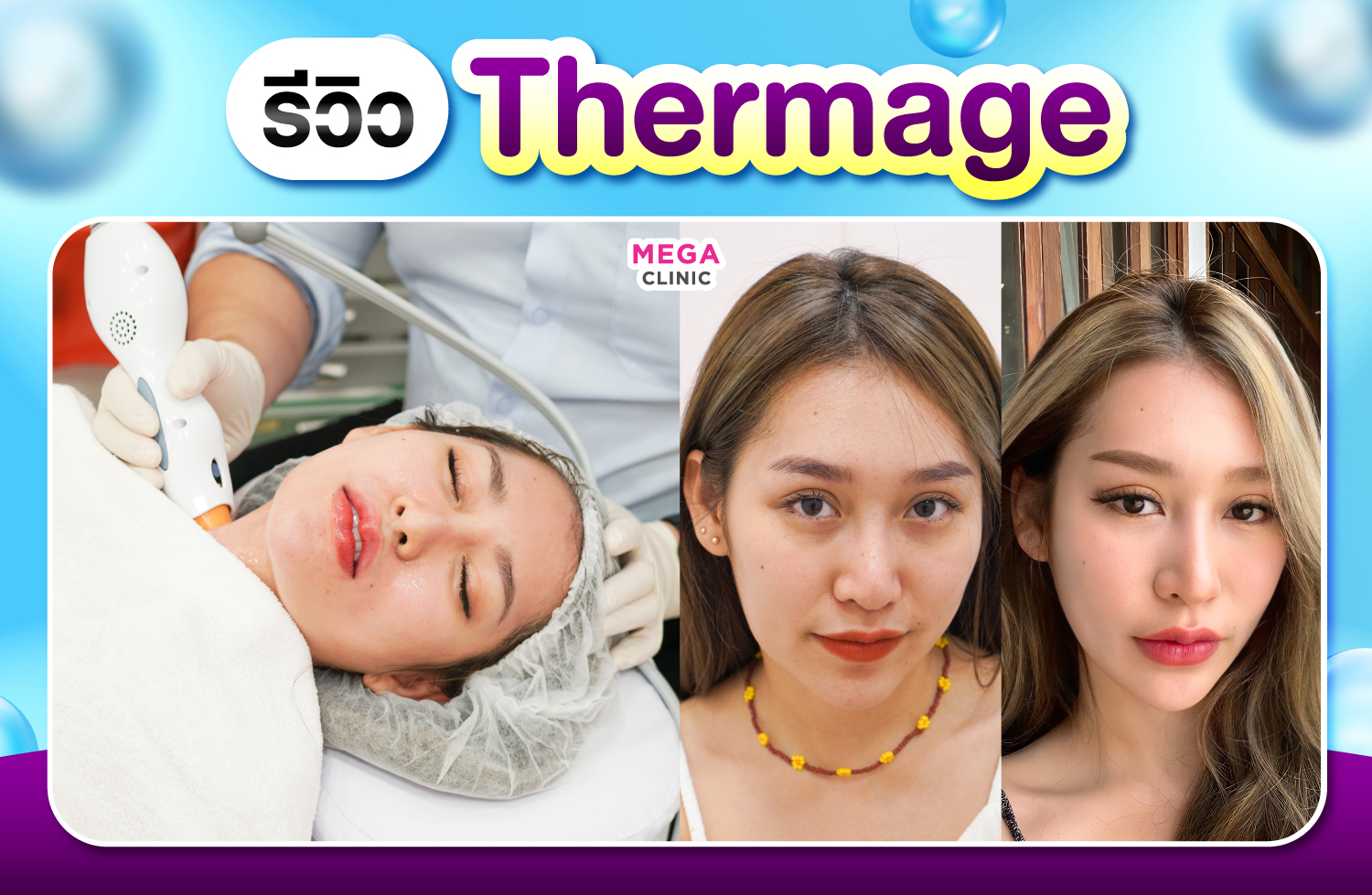 รีวิว thermage