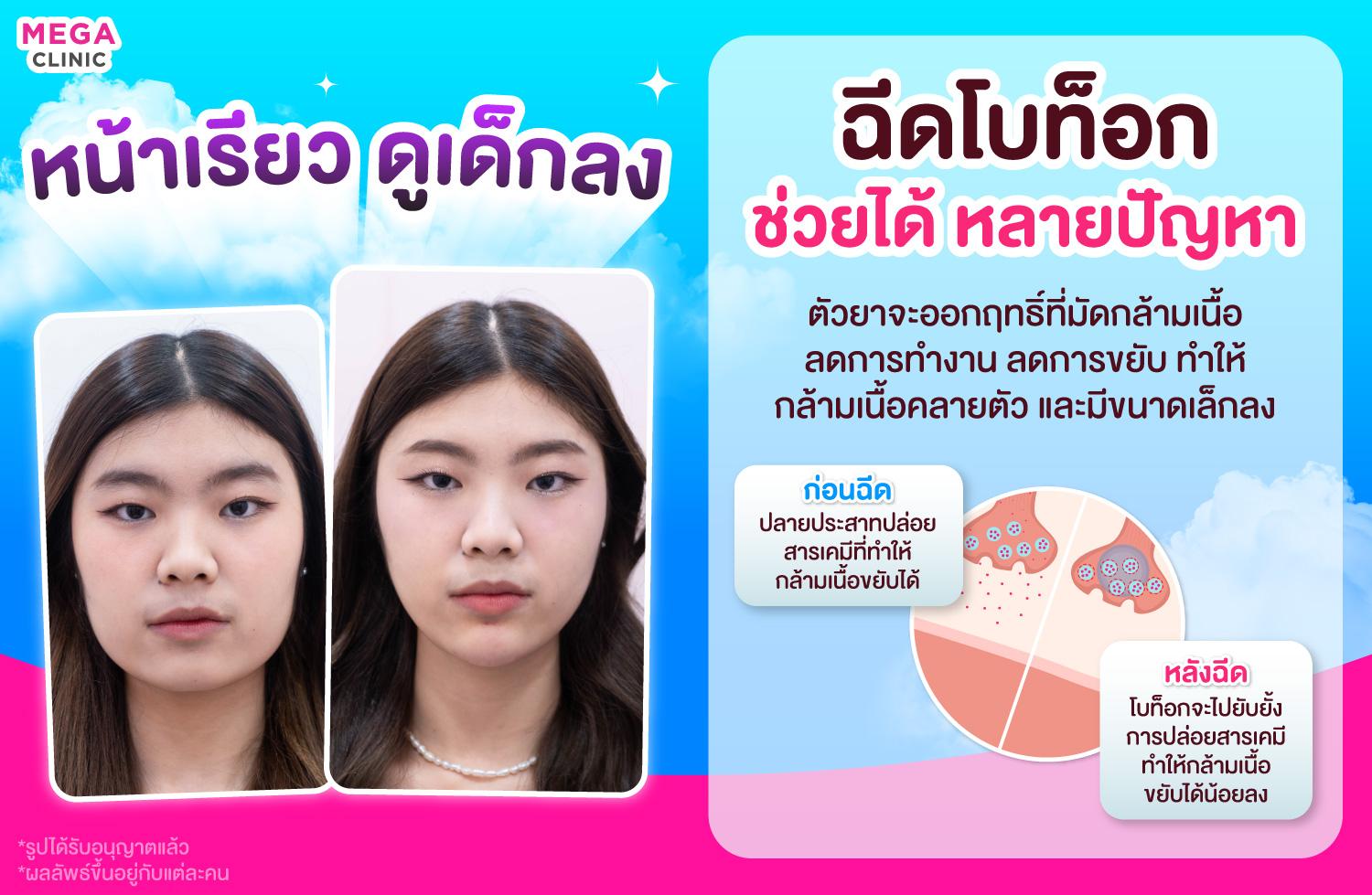 โบท็อกปรับหน้าเรียว ลดริ้วรอยหน้าเด็ก เมกะ คลินิก เซ็นทรัลเวสต์เกต