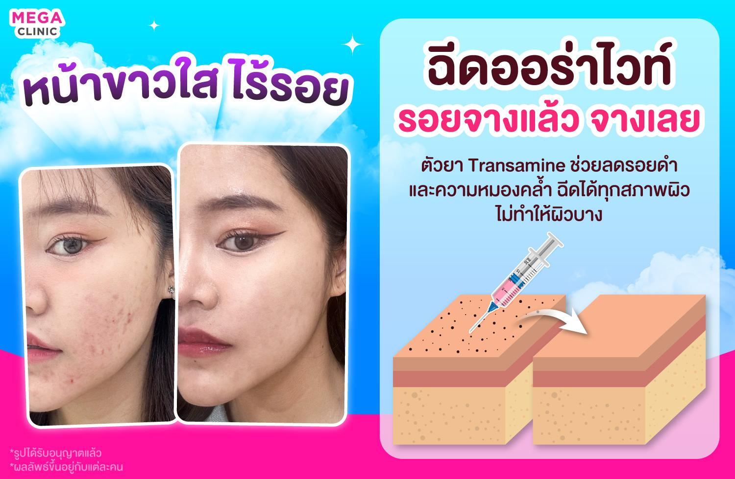 ฉีดออร่าไวท์ ลดรอยดำ ผิวหน้าขาวใส เมกะ คลินิก เซ็นทรัลเวสต์เกต