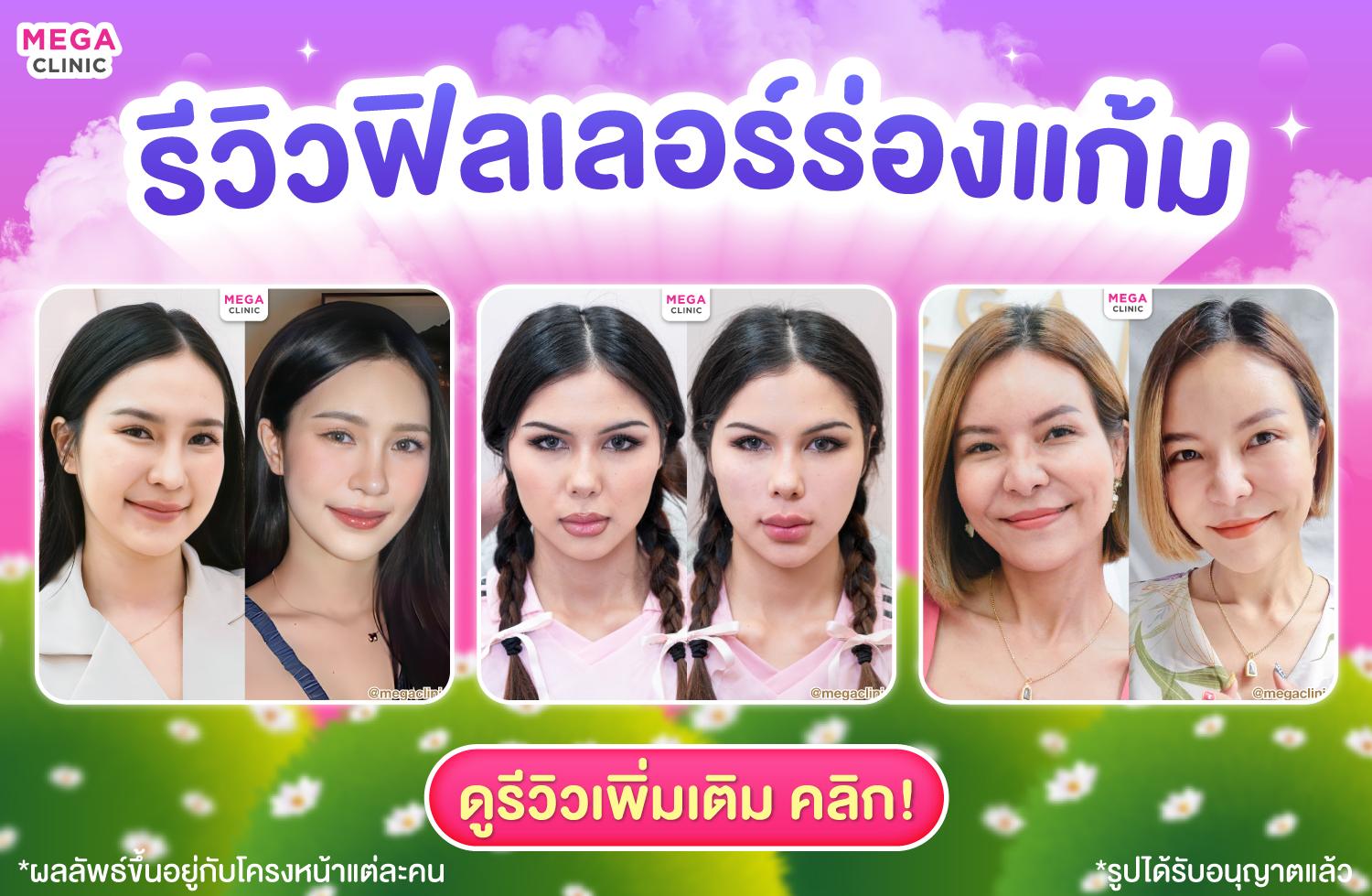 รวมรีวิวฟิลเลอร์ร่องแก้ม