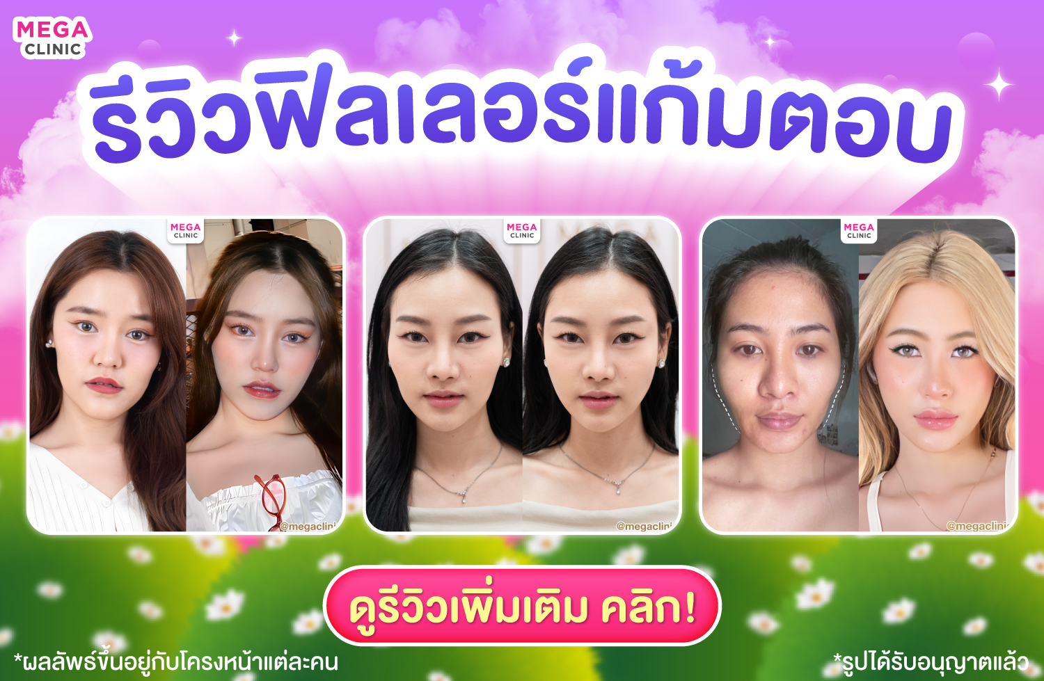 รวมรีวิวฟิลเลอร์แก้มตอบ