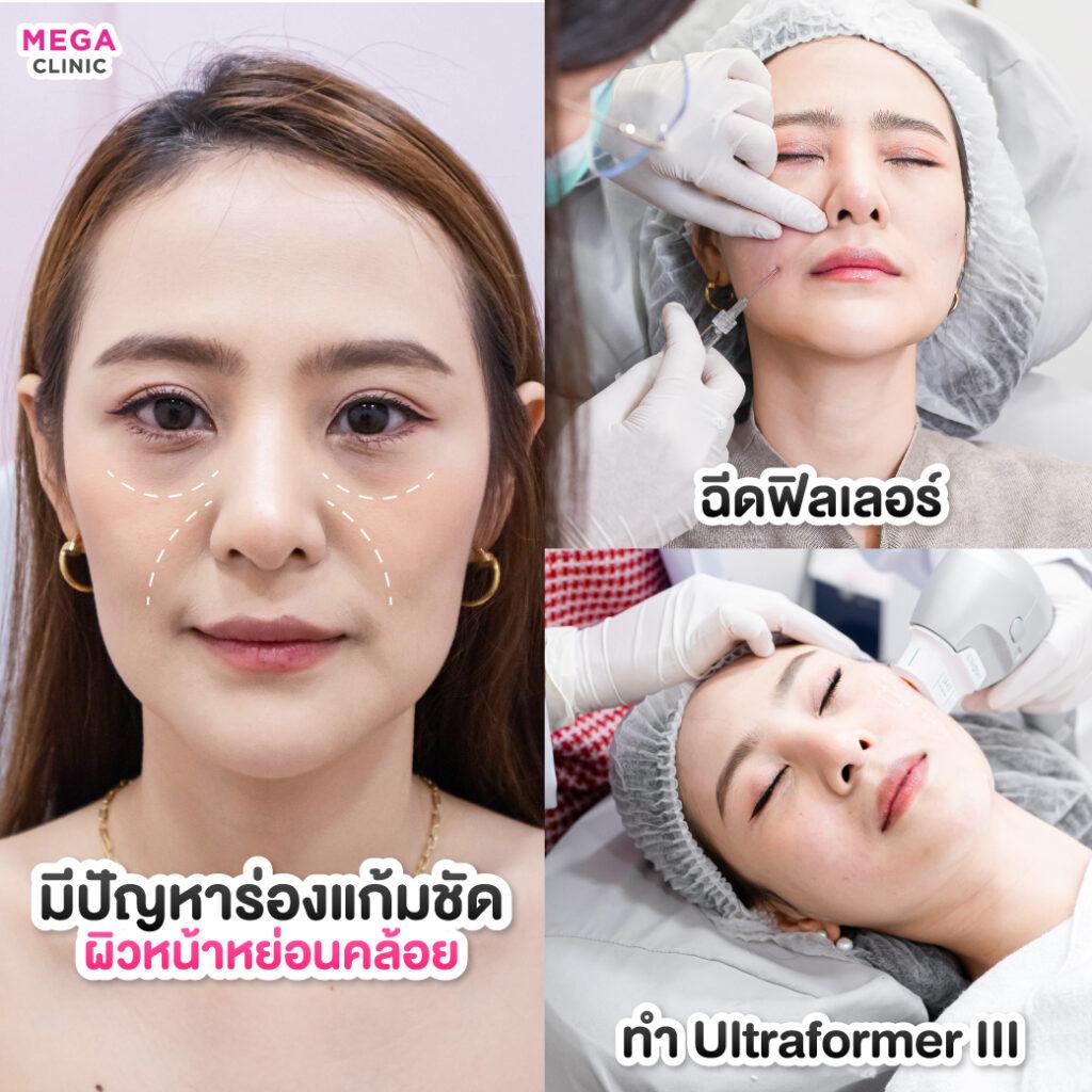 รีวิวฉีดฟิลเลอร์ แก้ปัญหาร่องแก้มชัด