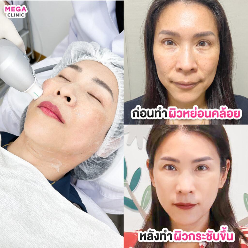 รีวิว Ultraformer แก้ผิวหย่อนคล้อย