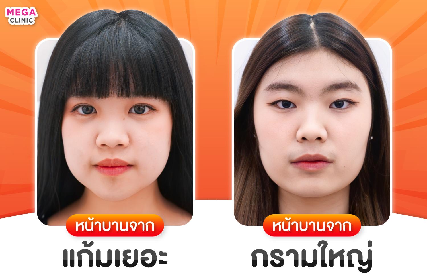 เปรียบเทียบ หน้าบานเพราะไขมัน vs หน้าบานเพราะกรามใหญ่