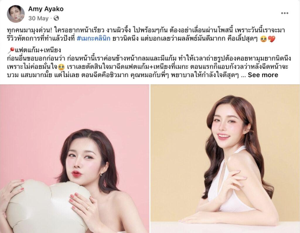 รีวิวลูกค้าจริงฉีดแฟต ลดแก้มเหนียง เมกะ คลินิก