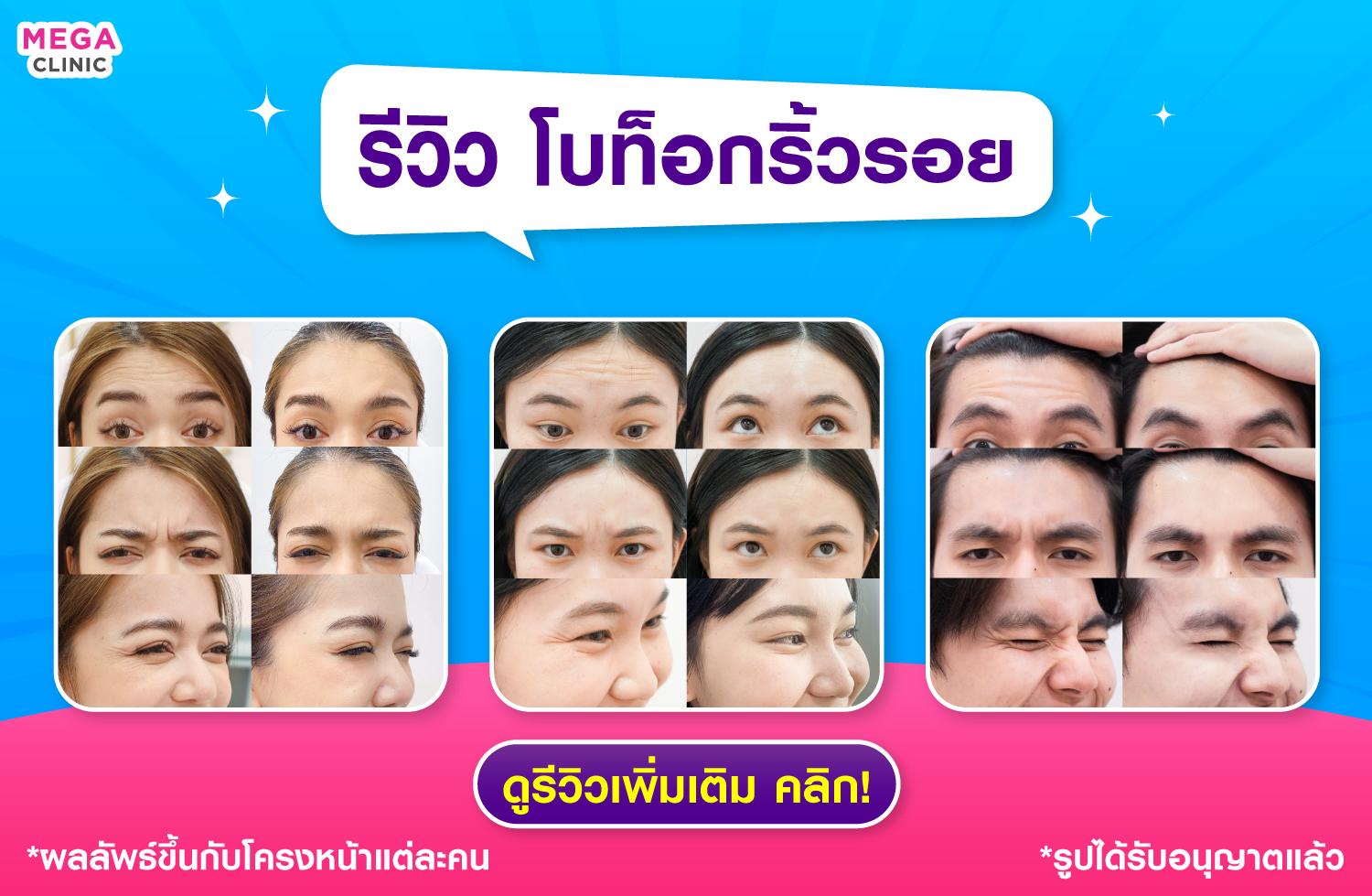 รีวิวโบท็อกริ้วรอย