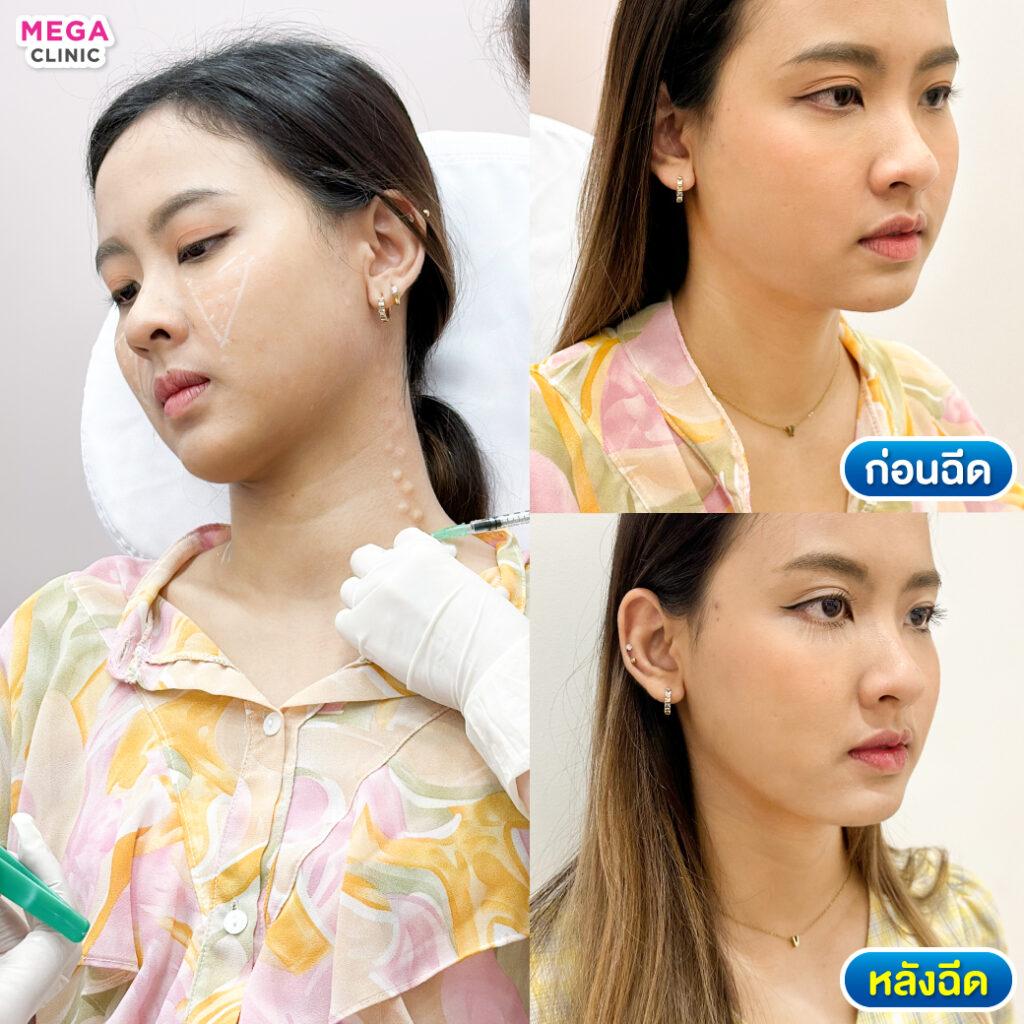 รีวิวBotox ลิฟท์ผิวคอให้กระชับ