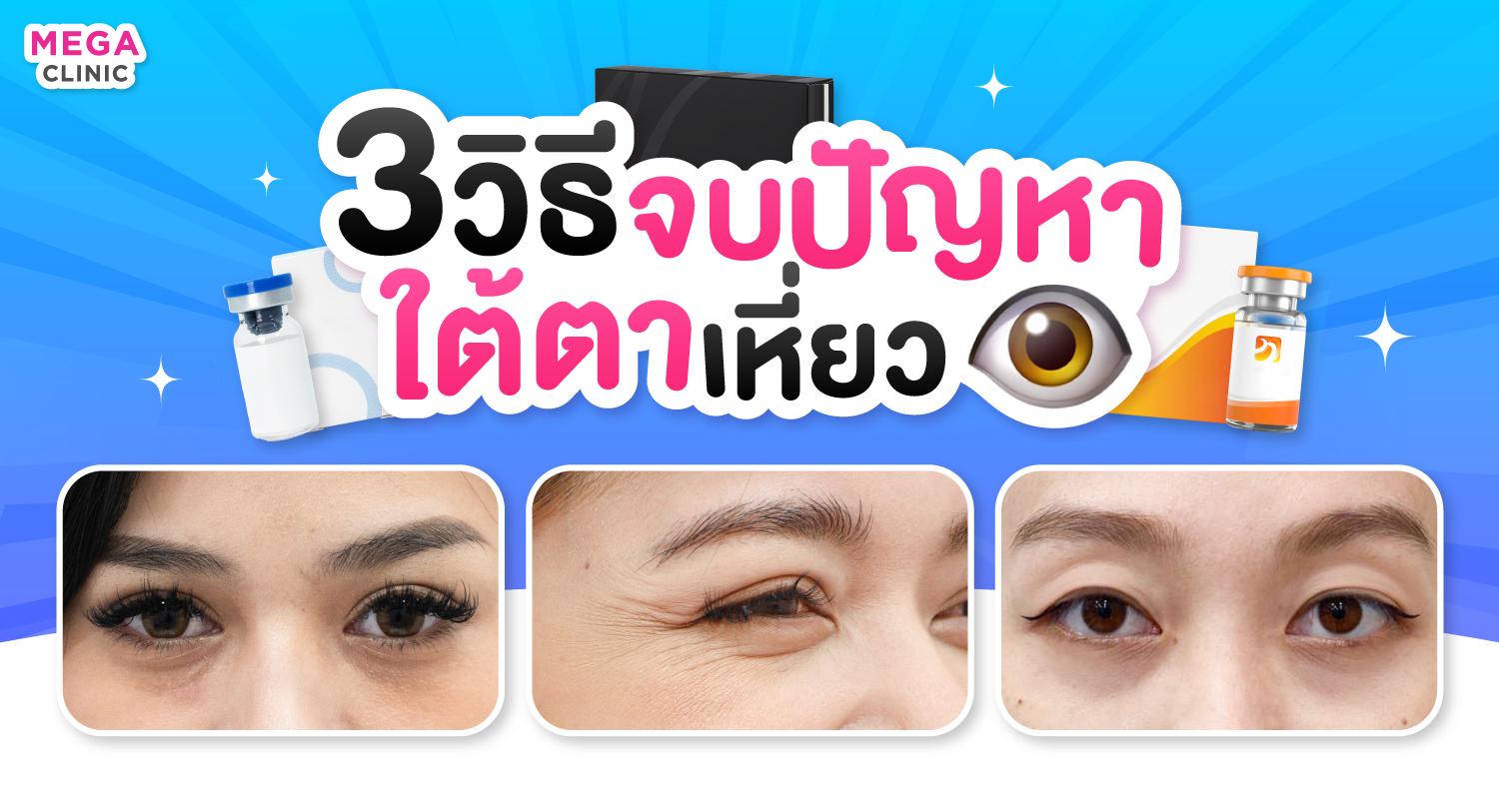 ริ้วรอยใต้ตา แก้ยังไง ใต้ตาเหี่ยว ฉีดอะไรดี