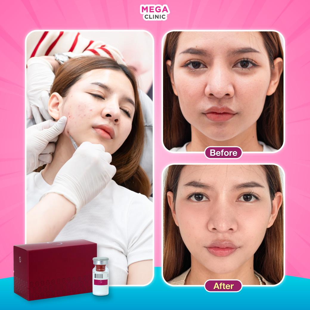 รีวิวฉีด Sculptra สำหรับคนที่กังวลหน้าแก่ก่อนวัย