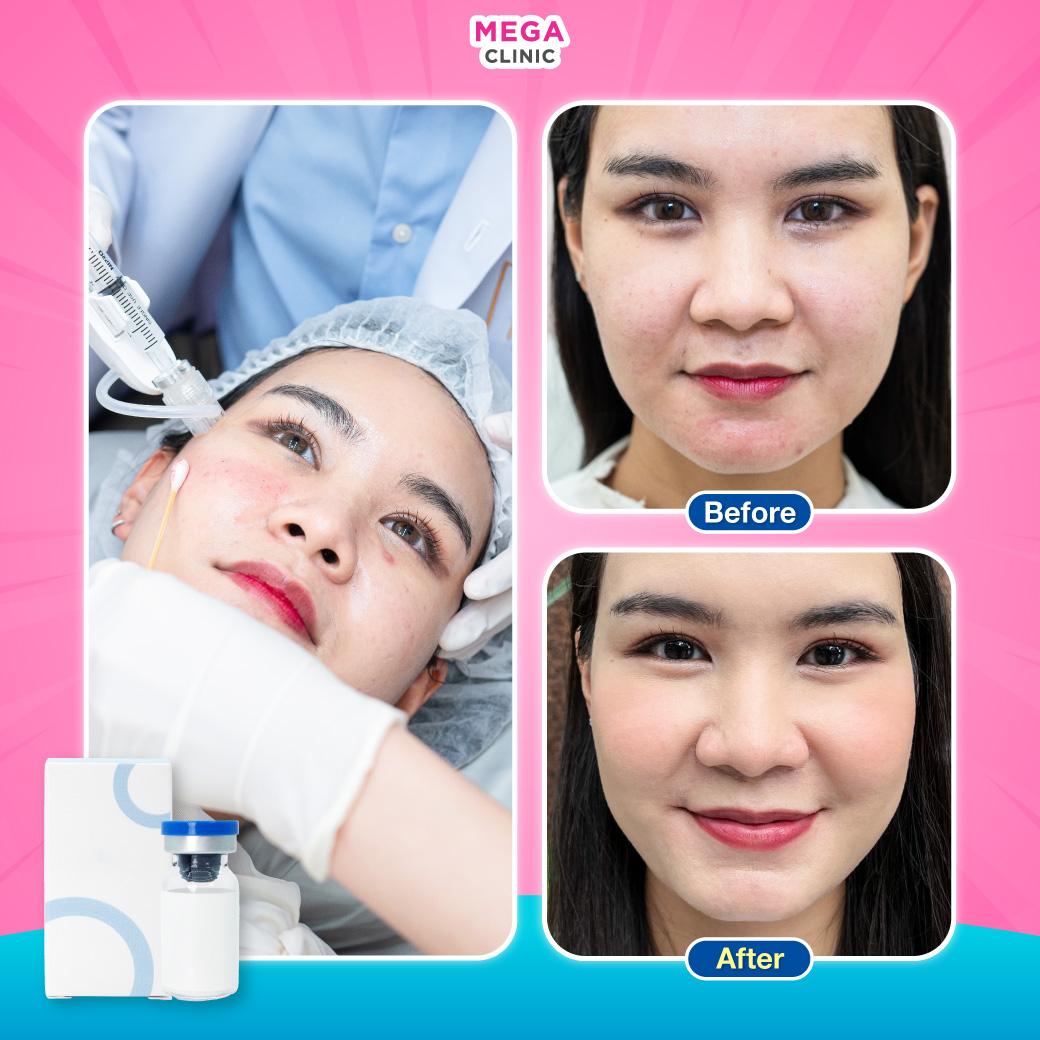 รีวิวฉีด Juvelook สำหรับคนที่กังวลหน้าแก่ก่อนวัย