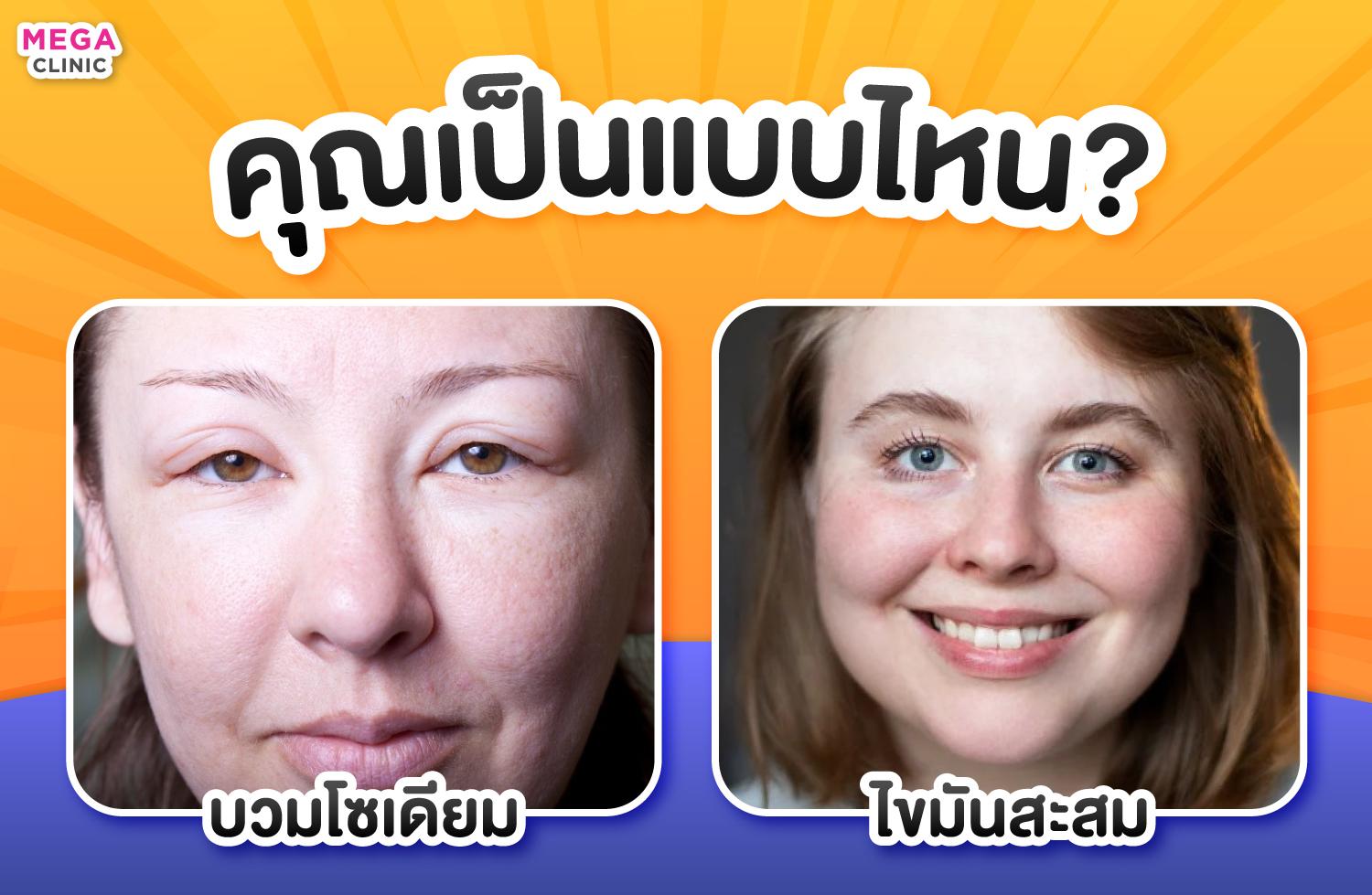 หน้าบวมโซเดียม vs ไขมันสะสมเพราะอ้วนขึ้น