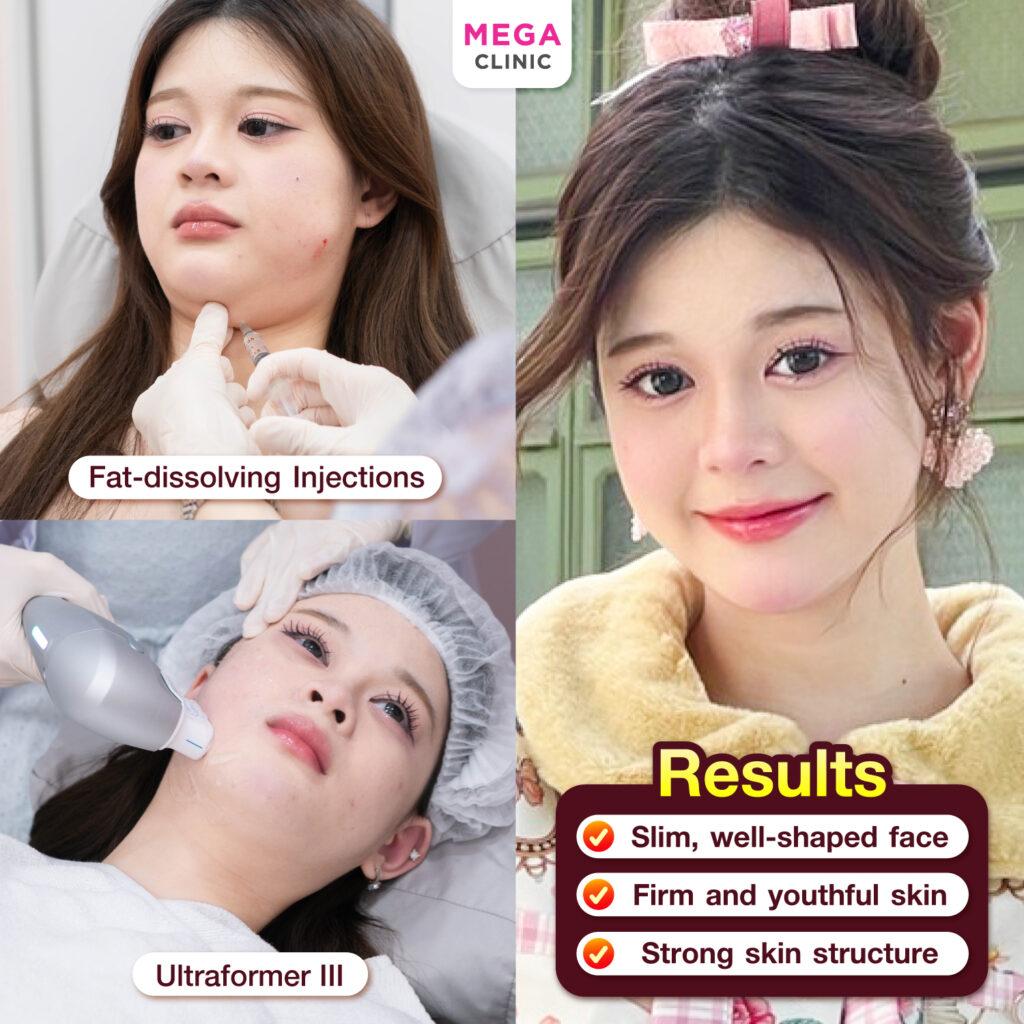 Tips for Long-Lasting Meso Fat Injection Results