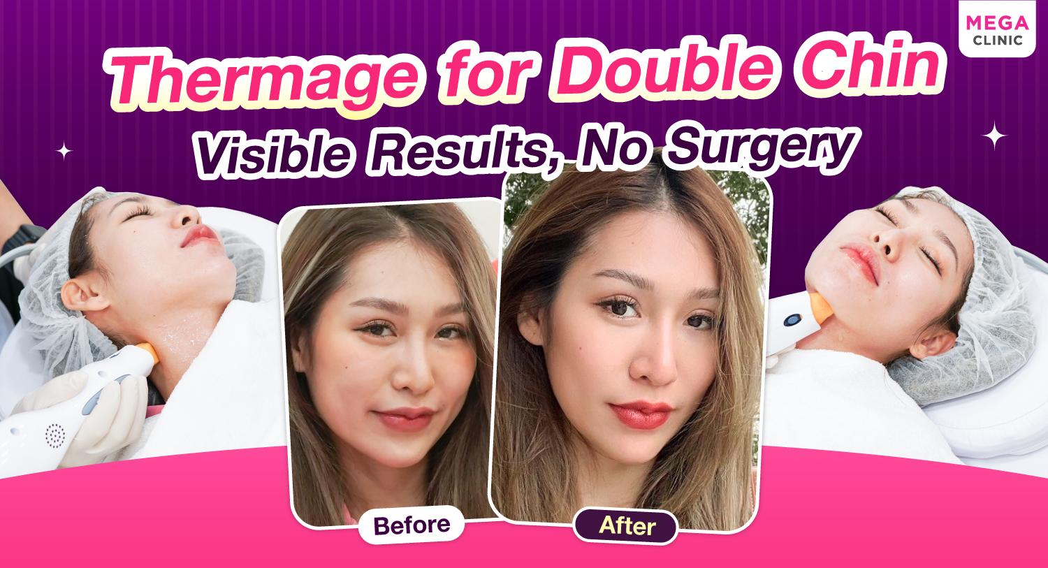 ลดเหนียงด้วย Thermage เห็นผลชัด โดยไม่ต้องผ่าตัด